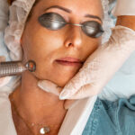 What To Know About Laser Treatments For Skin